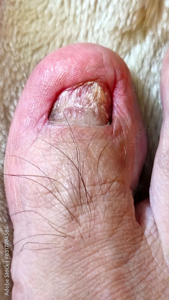 Fototapeta premium toe with sick nail