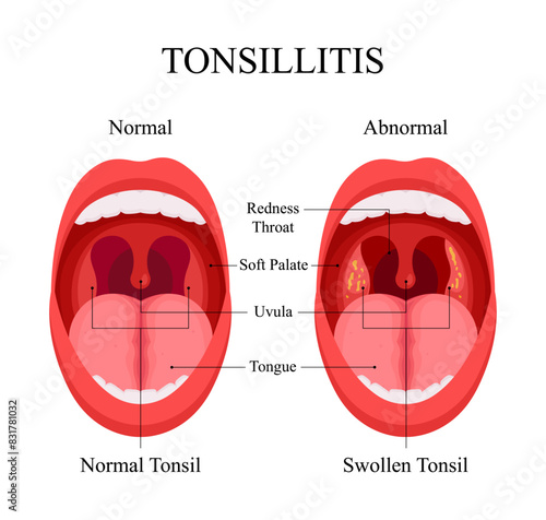 Diagram of Tonsillitis Causes, Normal Tonsils and Swollen Tonsils