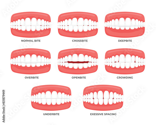 Set of Malocclusion types set with side view of normal, misalignment and incorrect relation between human teeth of upper and lower jaw vector illustration, Teeth trouble, vector illustration.