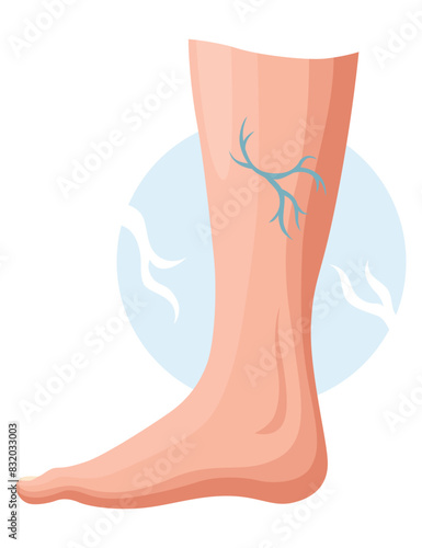 Stages or types of varicose veins development. Medical poster or disease infographic. Image of diseased legs. Vector illustration in flat style