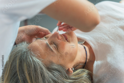 Photos Close-up of facial acupuncture treatment to an elderly woman