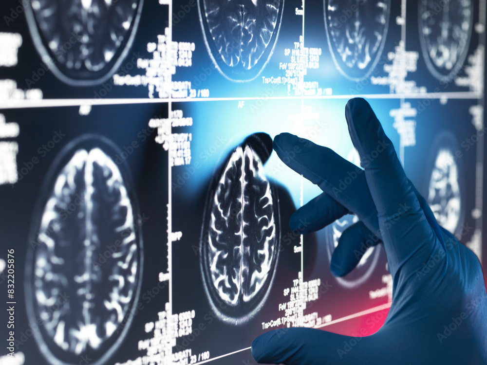 Neurology Research, Doctor examining a human brain scan on screen Stock ...