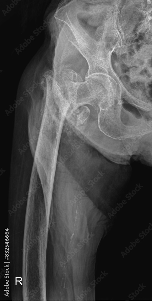 Digital Radiograph of Hip Fracture