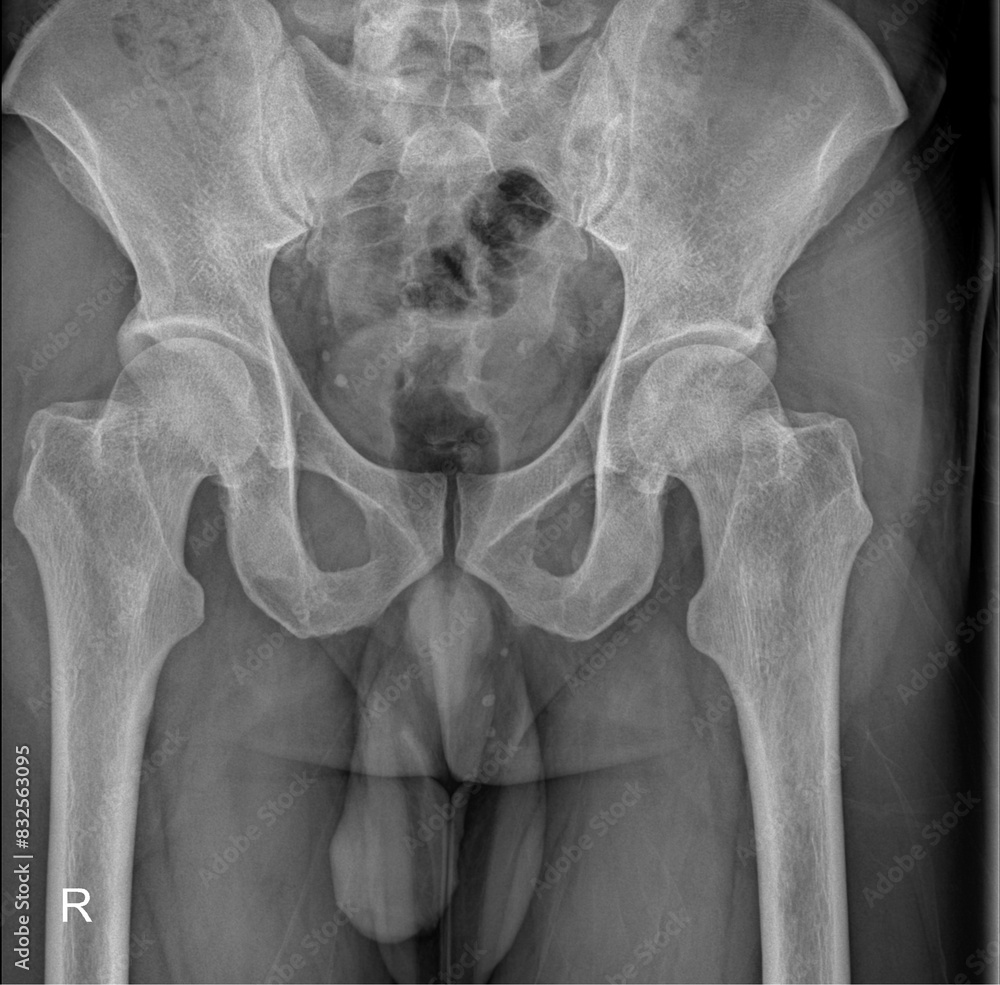 High-Resolution X-ray Scan of Human Hip Bones and Pelvis Stock Photo ...