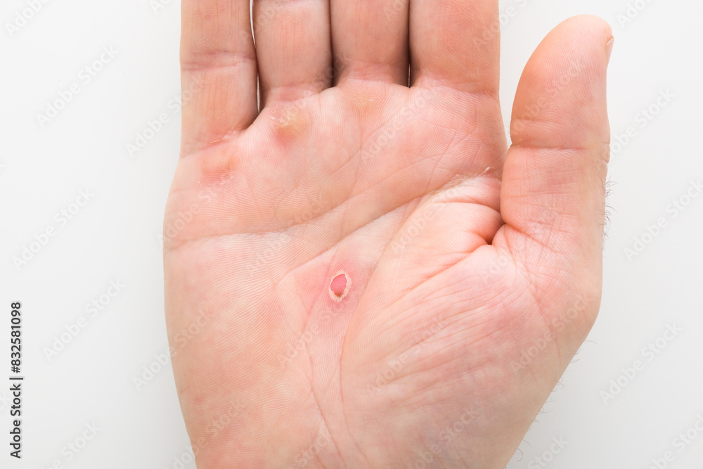 Young adult man palm with red callus after work on light gray table background. Closeup. Top down view. Young adult man palm with red callus after work on light gray table background. Closeup. Top down view.