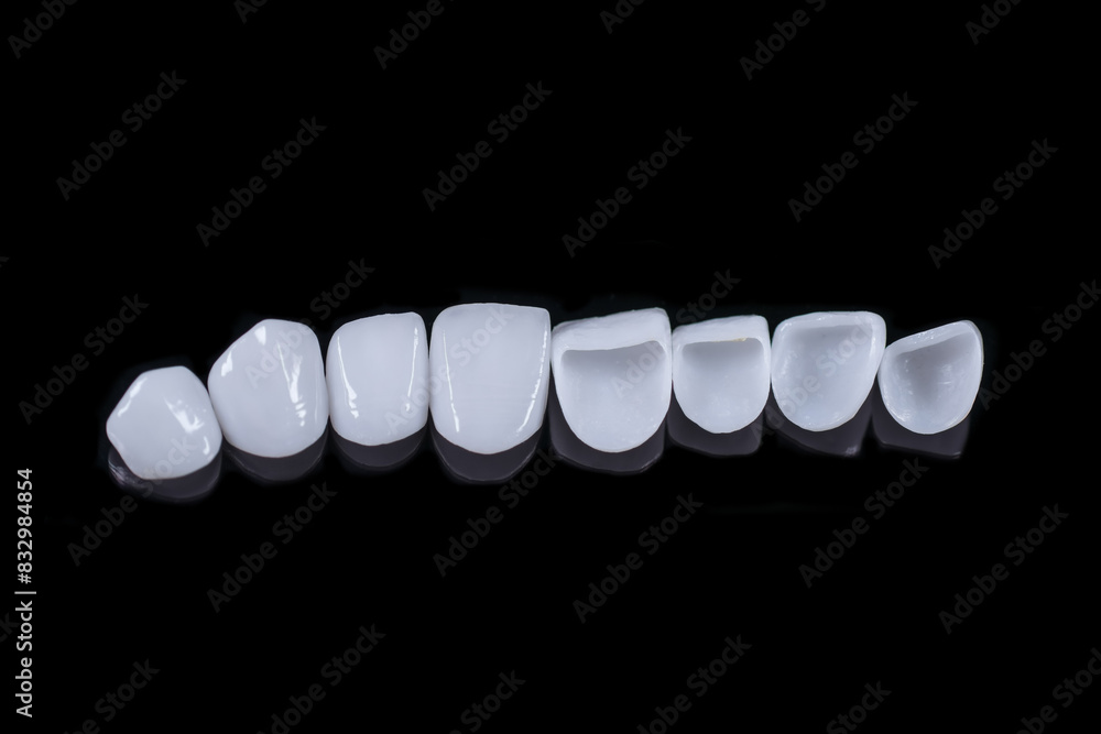 Model teeth, 8 , porcelain veneer teeth Model teeth, 8 , porcelain veneer teeth
