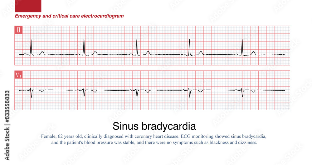 1677 SSinus heart rate less than 60 beats per minute in adults is called sinus bradycardia. A sinus heart rate of 40 to 50 beats per minute is moderate sinus bradycardia, and patients inus bradycardia 1677 SSinus heart rate less than 60 beats per minute in adults is called sinus bradycardia. A sinus heart rate of 40 to 50 beats per minute is moderate sinus bradycardia, and patients inus bradycardia
