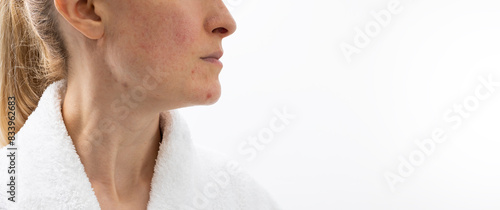 Design Cropped Face of Woman in her 30s with Acne Problem, Couperosis, Scarring, Blackheads. Horizontal Copy Space. Adult Skin Problem. Cosmetics and Healthcare, Beauty Concept. Rosacea.