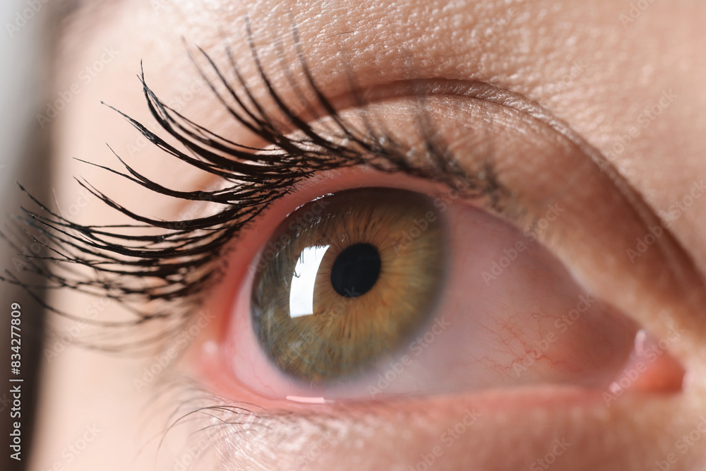 Fototapeta premium Woman with red eye suffering from conjunctivitis, closeup