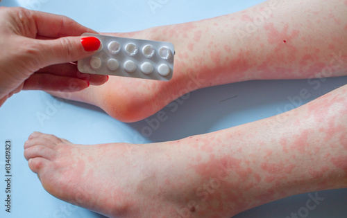 Woman hand with medicines and childrens legs with skin rash due to antibiotics alergy on light blue background 