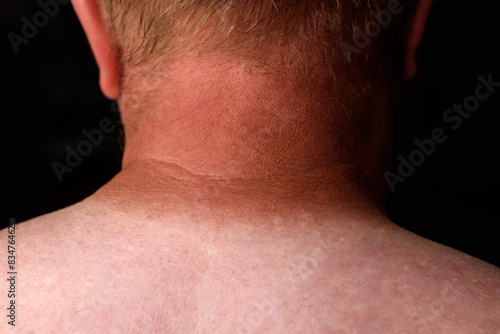 Sunburned skin on neck because of not using cream with sunscreen protection.