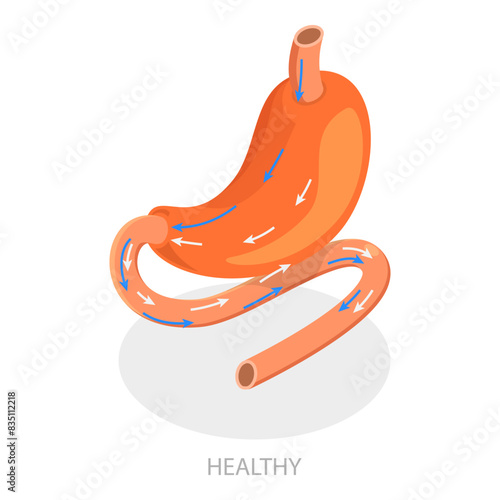 3D Isometric Flat Vector Illustration of Types Of Bariatric Surgery, Sleeve Gastrectomy. Item 4
