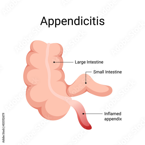 Diagram of appendix inflamed appendicitis disease