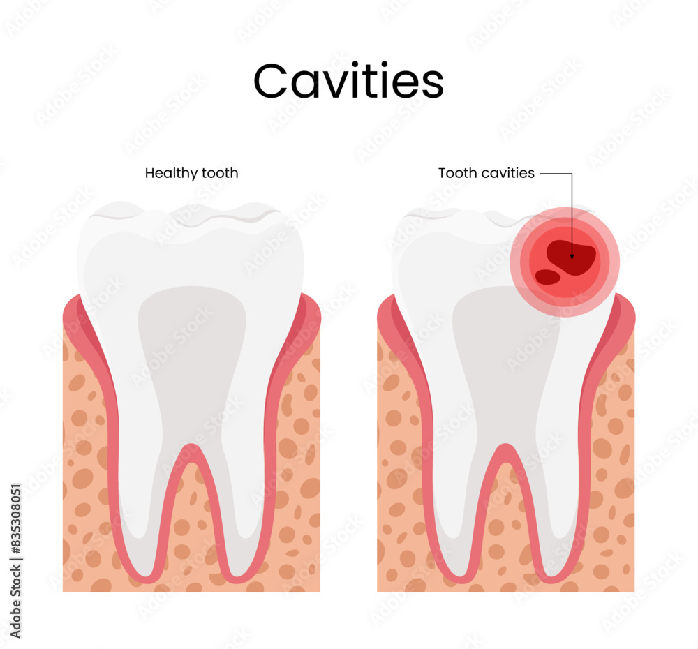 Cavities illustration healthy tooth and tooth cavities Cavities illustration healthy tooth and tooth cavities
