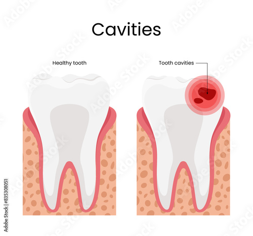 Cavities illustration healthy tooth and tooth cavities
