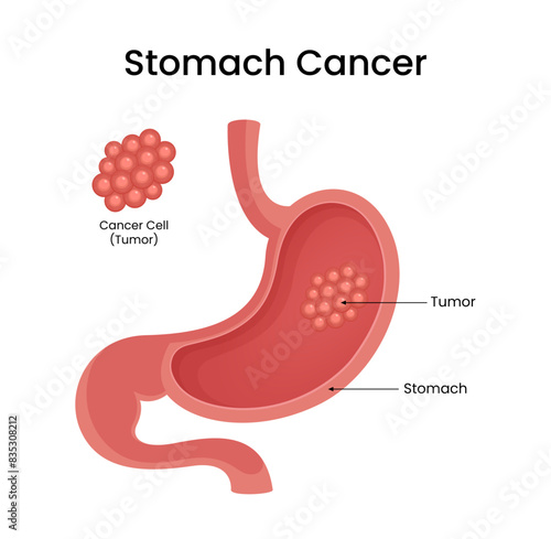 Stomach cancer vector design for medical