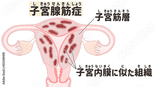 Adenomyosis labeled diagram Human anatomy PNG photo