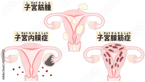 Uterine fibroids, Endometriosis and Adenomyosis; Labeled diagram PNG