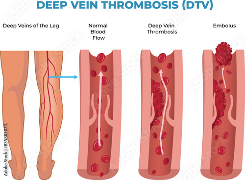 illustration of deep vein thrombosis diagram, DVT photo