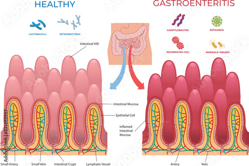 comparison illustration between healthy intestine and gastroenterintis