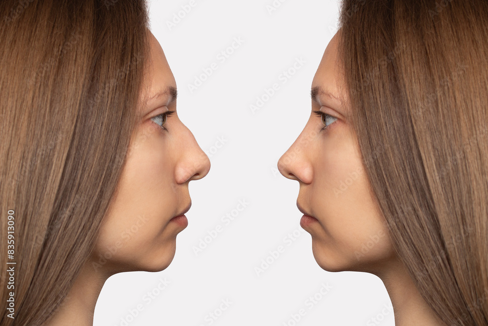 Collage before and after plastic surgery on the nose, isolated on a white background. Woman's face in profile. Correction of the nasal septum, rhinoplasty, septoplasty. Straightening the hump Collage before and after plastic surgery on the nose, isolated on a white background. Woman's face in profile. Correction of the nasal septum, rhinoplasty, septoplasty. Straightening the hump
