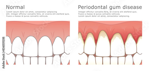 Periodontal disease medical illustration. Healthy gums and teeth illustration and periodontal disease symptoms. 