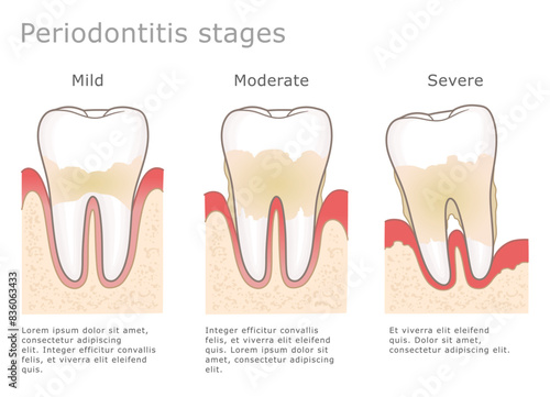 Periodontitis stages medical illustration