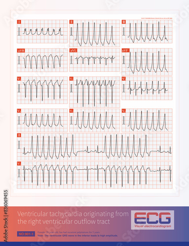 Ventricular tachycardia originating from the right ventricular outflow tract can be sustained or short-burst, and is a benign idiopathic ventricular tachycardia.