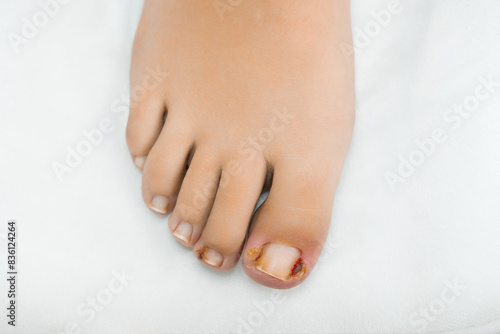 Close up woman feet after removing ingrown toenails. 