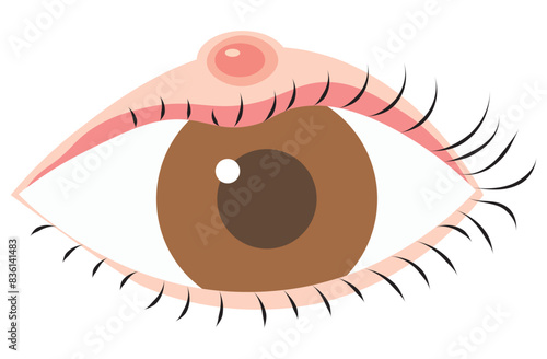 Angioedema is a rapid swelling of the deeper layers of the skin, often triggered by allergies. swelling around the eyes. It can be life-threatening if untreated, vector 