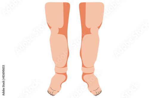 Angioedema is a rapid swelling of the deeper layers of the skin, often triggered by allergies. swelling the leg. It can be life-threatening if untreated.White skin