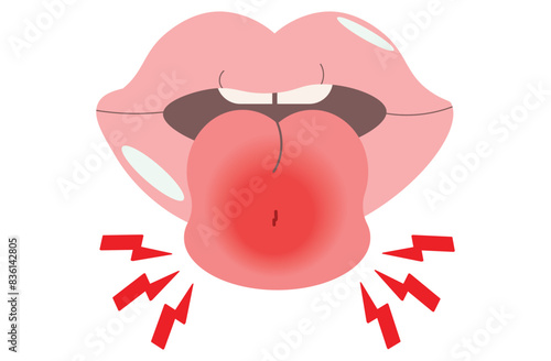 Angioedema is a rapid swelling of the deeper layers of the skin, often triggered by allergies. swelling around the tongue. It can be life-threatening if untreated,pink