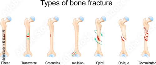 Types of bone fracture. Femur bone.