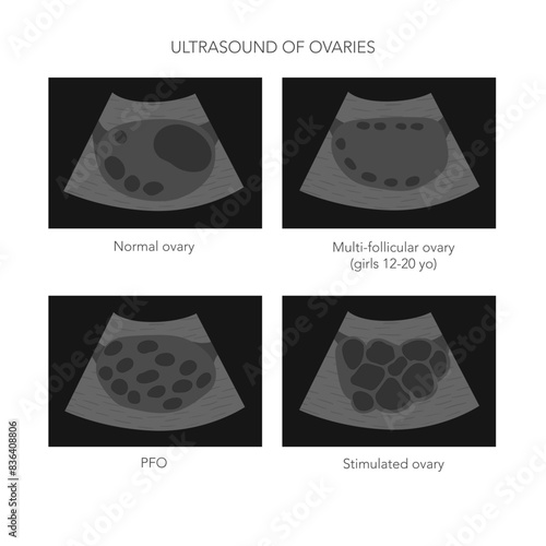 Medical vector illustration of ovaries ultrasound with normal, polycystic and stimulated ovary pictures.