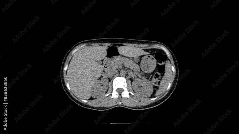 normal abdomen CT scan normal abdomen CT scan