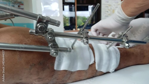 Doctor cleaning patient leg accident wound. Splinting with steel plates using screws to stick sheet metal  