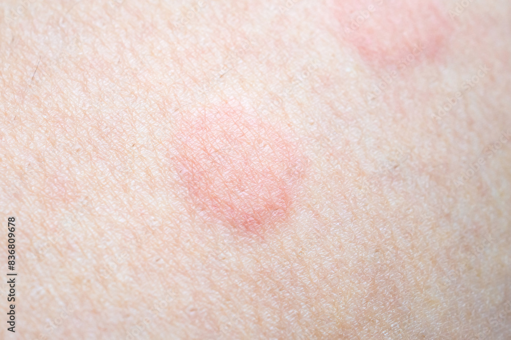 Fototapeta premium Skin allergy rash dermatitis texture close up