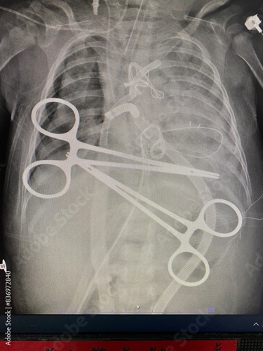 Film x-ray show right lung pneumothorax with pneumonia with central VA ECMO  for medical and technology concept photo