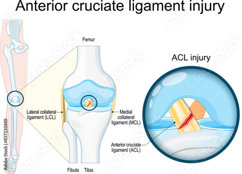 Anterior cruciate ligament injury. Close-up of a human knee joint