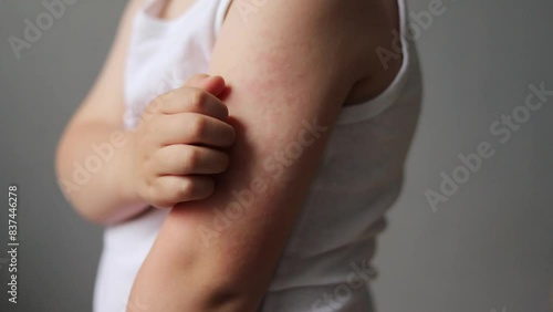 Child scratching arm with red rash