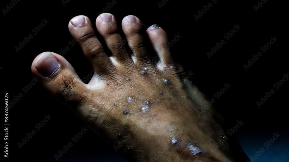 Close-up of feet with severe ulceration and dry wounds. Ideal for medical literature, healthcare presentations, or educational materials on skin conditions, diabetic foot care, and wound treatment. Close-up of feet with severe ulceration and dry wounds. Ideal for medical literature, healthcare presentations, or educational materials on skin conditions, diabetic foot care, and wound treatment.