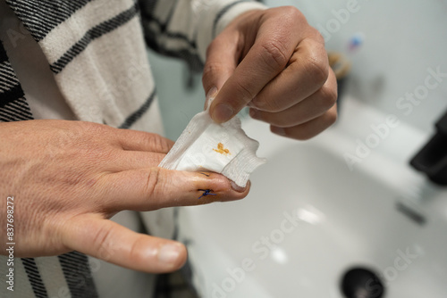 Anonymous man reveals freshly stitched wound while removing medical dressing post finger tendon surgery in bathroom. Postoperative Care