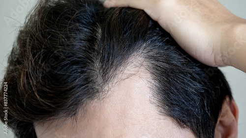 Photography Hair loss or alopecia problem