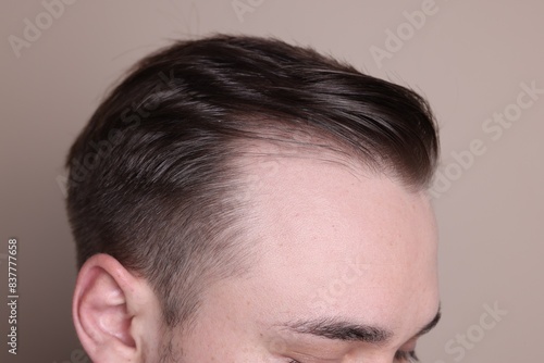 Baldness concept. Man with receding hairline on beige background, closeup