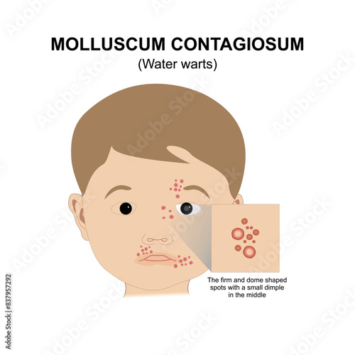 Molluscum Contagiosum Water Warts Illustration brown baby photo