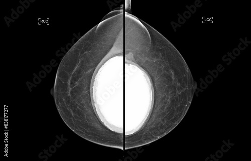 Foto The mammogram BI-RADS 2-benign shows a breast implant augmentation with visible signs of capsular contracture
