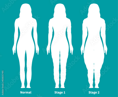 Teal Lipedema Silhouette Illustration with Woman with Normal and Lipedema Stages