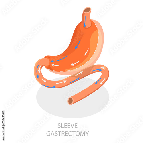 3D Isometric Flat Vector Illustration of Types Of Bariatric Surgery, Sleeve Gastrectomy. Item 5