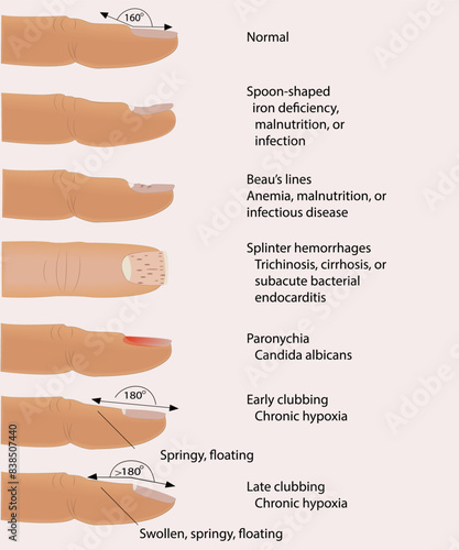 Medical illustration. Nail disease.informational poster for podiatrists. Nail diseases. Medicine and cosmetology. Vector illustration