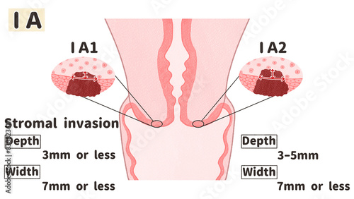 Cervical cancer stage 1A diagram PNG photo